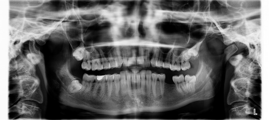 「歯周病」とは？原因と幹細胞を使った治療法を徹底解説！